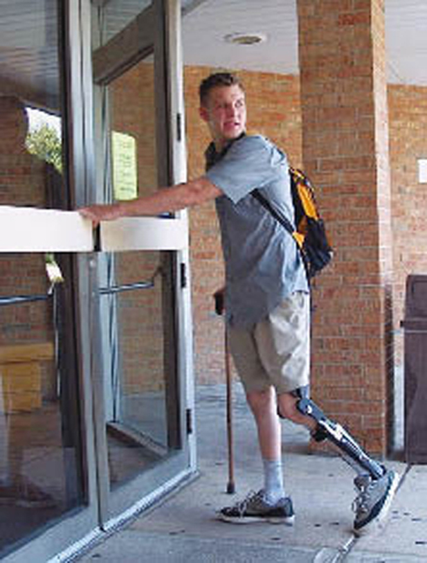 A patient wears the Stance ControlOrthotic Knee Joint ( SCOKJ).