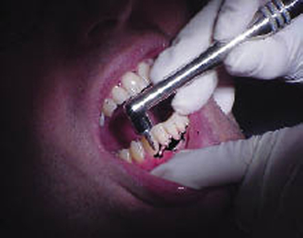 USProbe is used on a patient’s gums and teeth. 