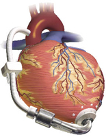 Heart pump Heart pump