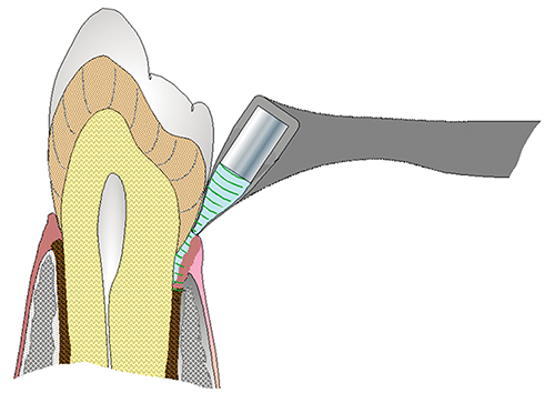 The USProbe device sends a signal between gums and teeth