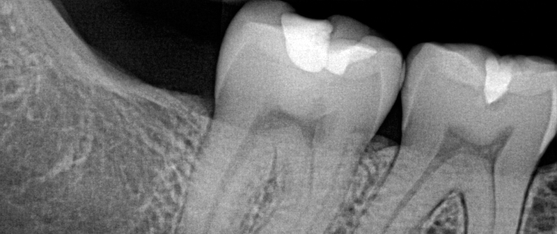 Dental X-ray