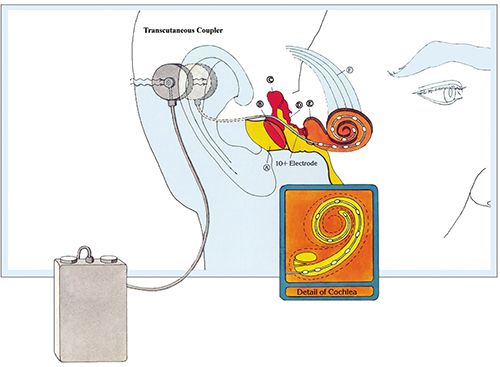 The cochlear implant produces electrical impulses in the ear