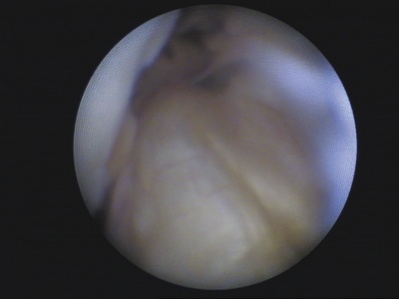 View of an Anterior Cruciate Ligament inside of a knee