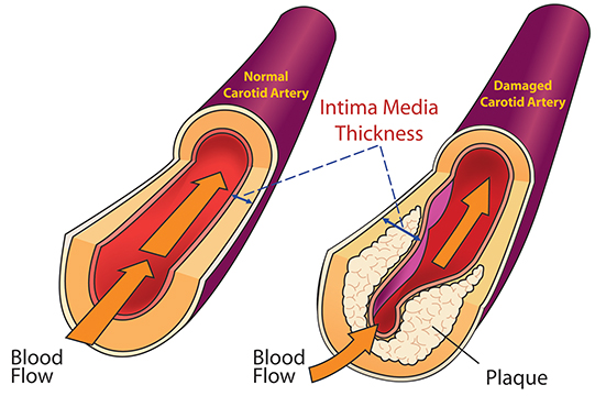 Atherosclerosis diagram