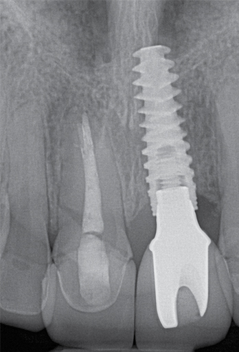 Dental implant