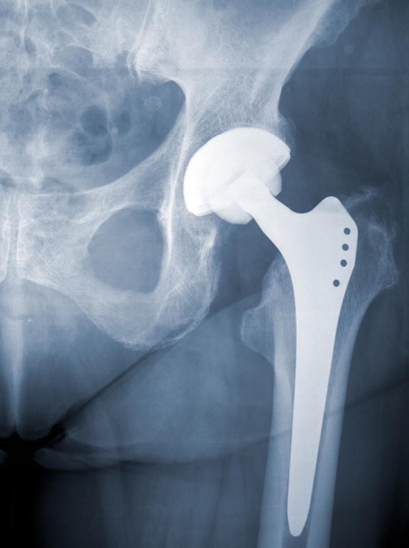 Hip replacements are typically made of metal and polymer composites. Imitec used the knowledge gained from NASA SBIR research to develop a new, more durable polymer material that's being tested in these specialized implants. Credit: Rike_/Getty Images an x-ray of a hip replacement