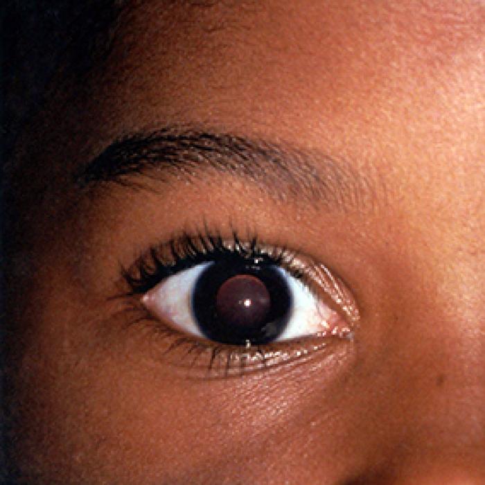 Close-up of child’s eyes showing anisometropia, or lazy eye