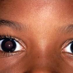 Close-up of child’s eyes showing anisometropia, or lazy eye